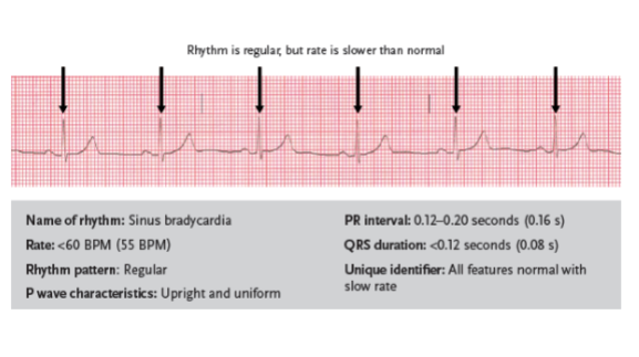 <p>a slow sinus rhythm with normal characteristics but with a rate below 60 BPM</p><ul><li><p>Dizziness</p></li><li><p>Weakness</p></li><li><p>Syncope (fainting)</p></li><li><p>Changes in mental status/consciousness</p></li><li><p>Chest pain</p></li><li><p>Shortness of breath</p></li><li><p>Clammy skin</p></li><li><p>Low blood pressure</p></li></ul><p></p>