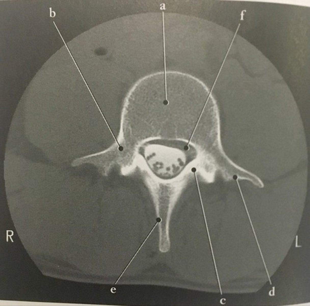 <p>Identify structure E on this axial CT slice of the lumbar vertebra.</p>
