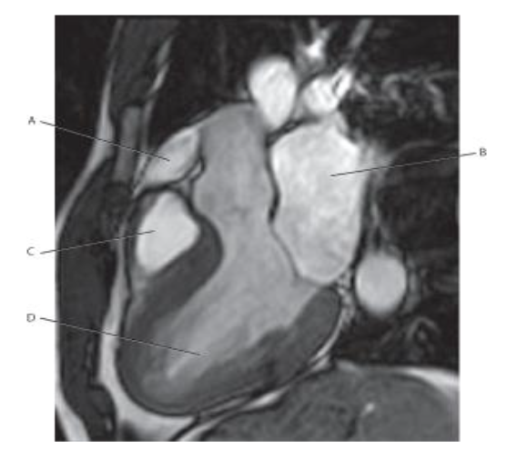 <p>Which line points to the <span style="color: red">pulmonary trunk?</span></p>