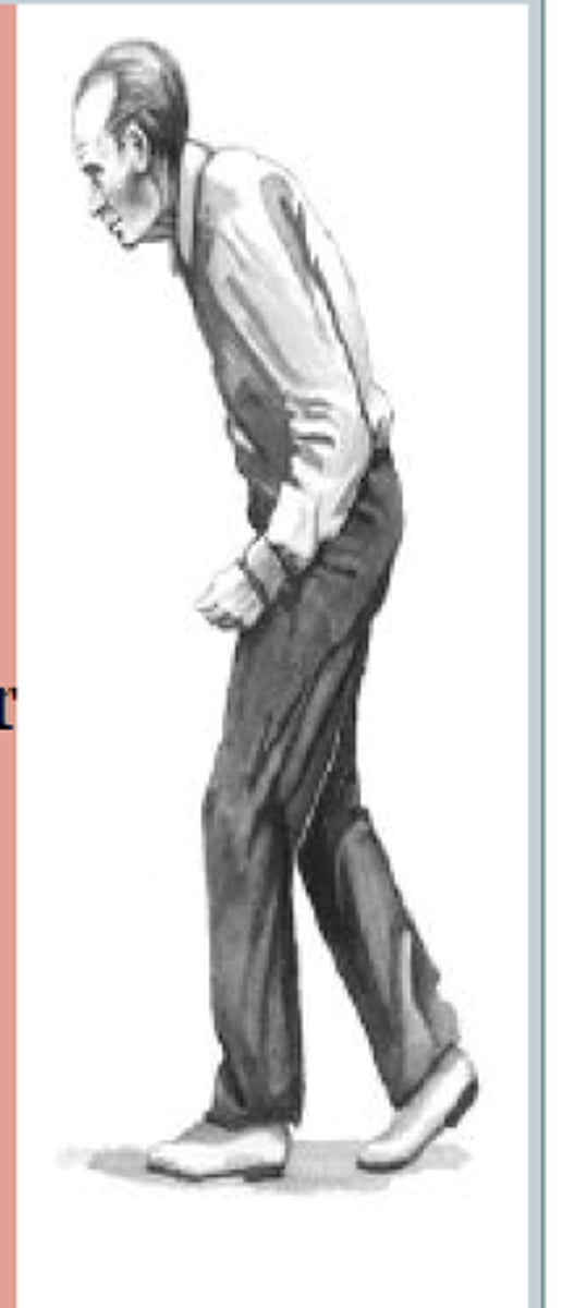 <p>Stooped posture with small shuffling steps of low ambulatory efficiency.</p>