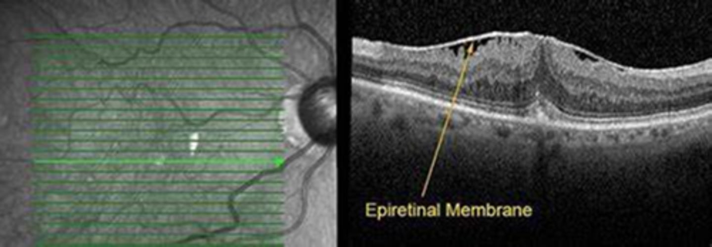 <p>macular pucker with retinal striae</p>