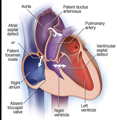 <p>Tricuspid Atresia</p>