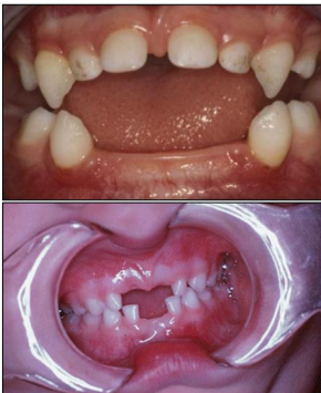 <ul><li><p>lack of cementum </p></li><li><p>premature loss of teeth: esp lower incisors </p></li><li><p>bone abnormalities </p></li></ul><p></p>