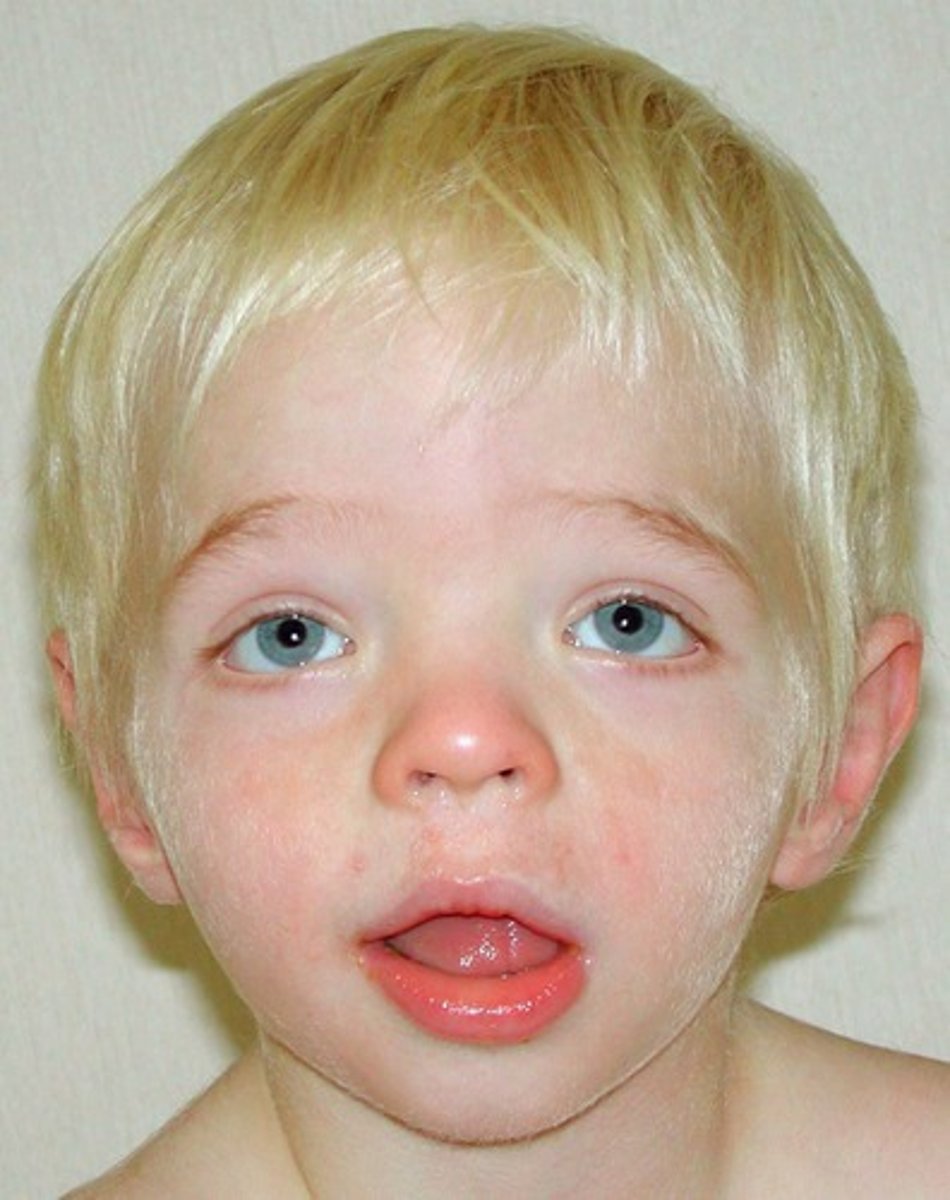 <p>- Wider eye separation</p><p>- Smaller nose bridge</p><p>- Thin upper lip</p><p>- Smaller ears</p><p>- Flat midface</p>