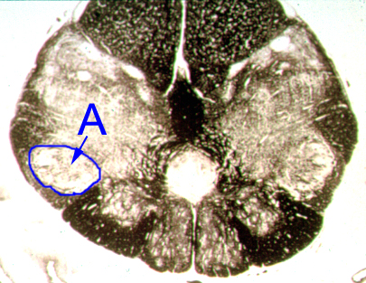 <p>Identify the structure indicated by the outline and letter "A".</p><p><span>A. Fasciculus cuneatus</span></p><p><span>B. Fasciculus gracilus</span></p><p><span>C. Spinal trigeminal nucleus</span></p><p><span>D. Anterolateral system</span></p><p><span>E. Pyramidal decussation</span></p><p></p>
