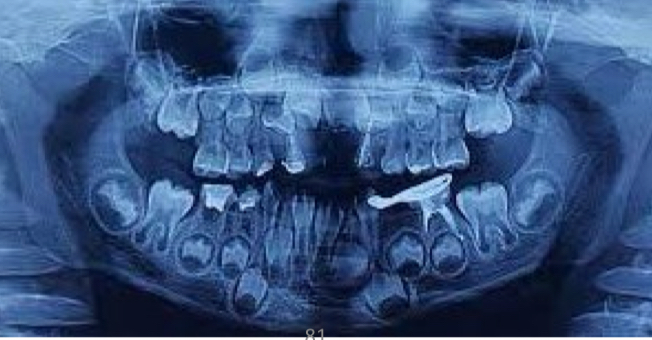 <p>Environmental factors shorten the arch length, no tooth bone discrepancy </p>