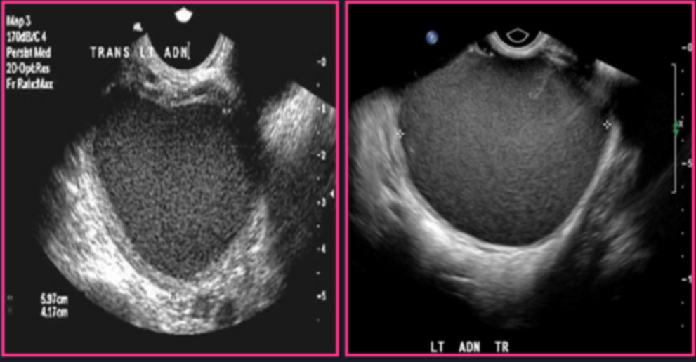 <p>Chocolate cysts are “___” and _____ to the uterus, cul de sac, or rectosigmoid </p>