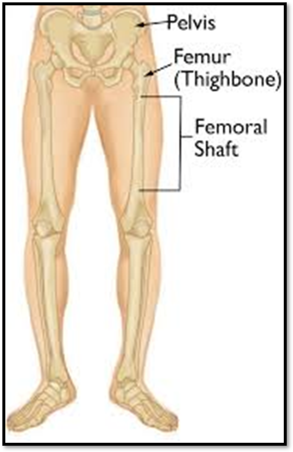 <p><span>•Occurs with a severe direct force, usually in younger adults</span></p><p><span>•</span><strong><u><span>Signs/Symptoms: </span></u></strong><span>Obvious, marked deformity and angulation, shortening of extremity, inability to move hip or the knee, PAIN</span></p><p><span>•</span><strong><u><span>Complications: </span></u></strong><span>fat embolism, nerve and vascular injury&nbsp;&nbsp;&nbsp;&nbsp;&nbsp; </span><strong><u><span>Diagnostic: </span></u></strong><span>Xray</span></p><p><span>•</span><strong><u><span>Treatment: </span></u></strong><span>1<sup>st</sup>~Stabilize pt and immobilize fracture, intramedullary nailing, internal fixation.</span></p><p><span>•</span><strong><u><span>Nursing post-op: </span></u></strong><span>educate on weight bearing, maintain strength in affected leg, perform ROM, full weight bearing restricted until xray evidence shows union of fracture.</span></p>