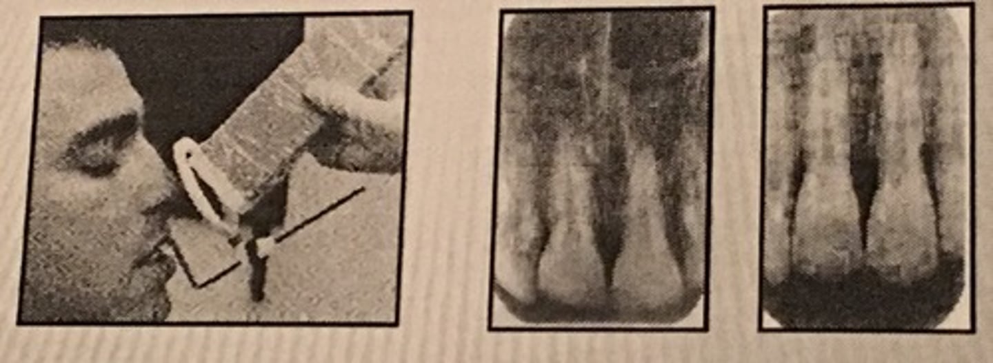<p>1. PID Too steep Vertical angulation</p><p>2. Foreshortening of the image: Excessive angulation (Too Steep)</p><p>3. Elongation of the image: Insufficient vertical angulation</p>