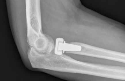 <p>Indications for Radial Head Replacement </p>