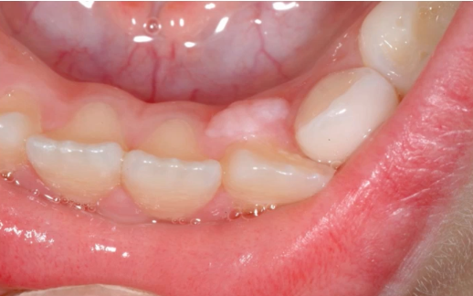 <p>occurs in younger age group, diagnosis?</p>