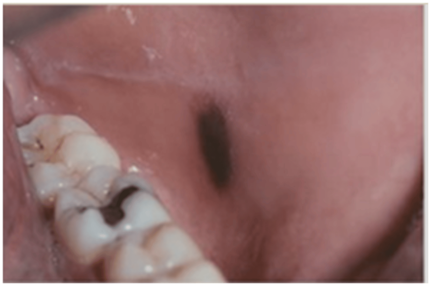 <p>which type of pigmented lesion:</p><p>• Benign</p><p>• Acquired pigmentation</p><p>• Reactive</p><p>• Female predilection</p><p>• More common in those of</p><p>African descent</p><p>• Lesions rapidly increase in size</p><p>• Flat, brown to black</p><p>• Irregular borders</p>