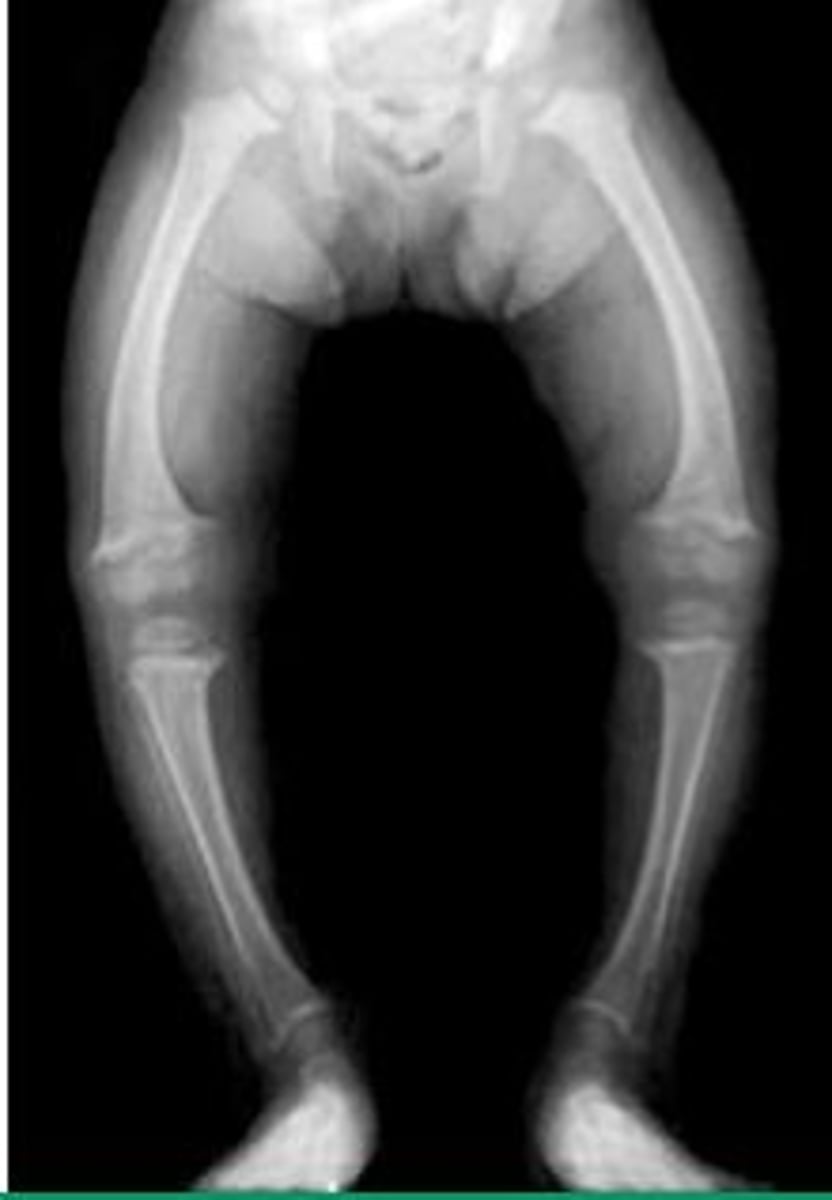 <p>What is it?</p><p>- defective mineralization of osteoid (osteomalacia) or cartilaginous growth plates (rickets, only in children)</p><p>- most commonly due to vitamin D deficiency</p><p>Pathogenesis?</p><p>- decreased vitamin D --> decreased serum Ca2+ --> increased PTH secretion --> decreased serum phosphate</p><p>X ray findings?</p><p>- osteopenia and "Looser zones" (pseudofracture) in osteomalacia</p><p>- epiphyseal widening and metaphyseal cupping/fraying in rickets</p><p>- children with rickets have bow legs, bead-like costochondral junctions (rachitic rosary), craniotabes (soft skull)</p>