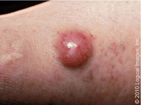<p>Merkel Cell Carcinoma </p>
