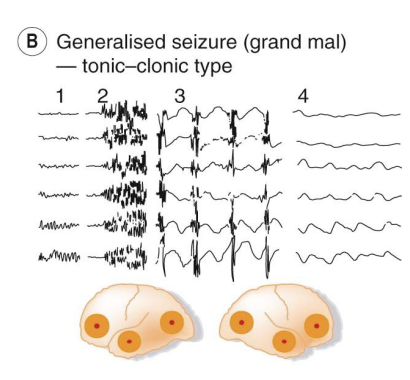 <p>Split into 4 phases: </p><p>1 – normal activity, </p><p>2 – onset of the tonic phase with extensive activity (seen physically by contraction of the whole musculature, respiration ceases, defecation/micturition/salivation, face turns blue), </p><p>3 – clonic phase with intermittent discharges (a series of violent, synchronous jerks that die out over a few minutes)  </p><p>4 – post-convulsive coma with minimal activity in 2 all regions (unconsciousness, followed by waking of patient in a confused and often ill feeling state)</p>