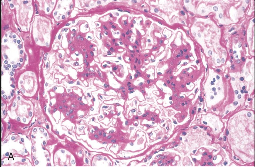 <ul><li><p>Glomérulos normales o con ensanchamiento mesangial</p></li><li><p>Presencia de leucocitos en capilares glomerulares</p></li><li><p>Lesiones visibles: la curación lleva a esclerosis focal y segmentaria, necrosis con formación de estructuras semilunares</p></li></ul><p></p>