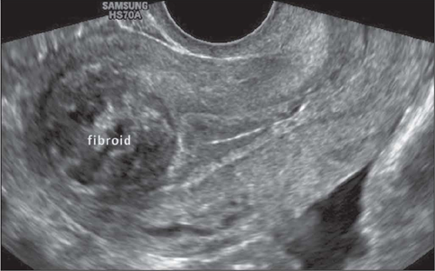 <ul><li><p>bleeding</p></li><li><p>ANEMIA</p></li><li><p>fertility issues </p></li></ul><p>what location is this</p>