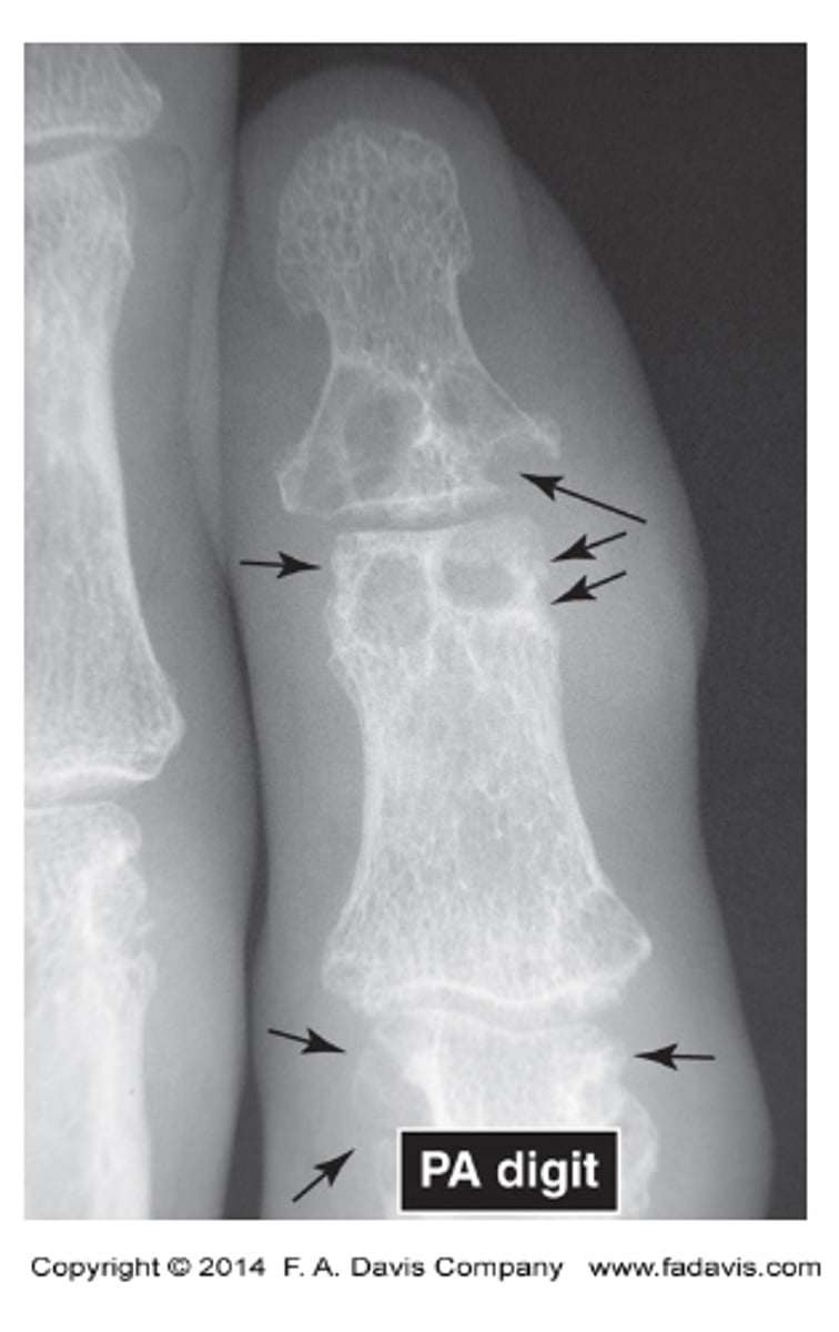 <p>Subchondral bone erosions</p>
