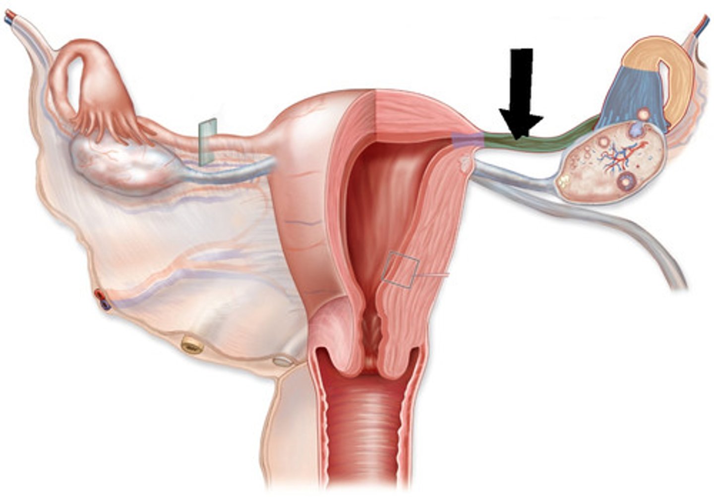 <p>passes through uterine wall, opens into lumen of uterus</p>