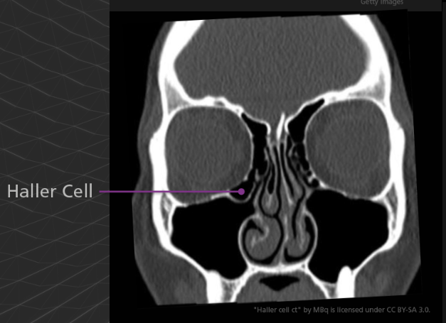 <p>A Haller cell is an extension of an ethmoid air cell into the inferomedial orbital floor. Although usually asymptomatic, is can become significant the same way as an Onodi cell. For example, an endoscopic surgeon who is unaware of a Haller cell may accidentally penetrate the orbit.</p>