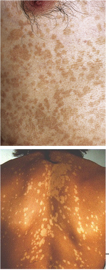 <p>The fungus requires <strong>high levels of exogenous lipids</strong> to grow. </p><p><strong>By-products of lipid metabolism</strong> interfere with <strong>tyrosinase in melanocytes</strong>, thereby <strong>altering melanin production</strong> and skin color.</p>