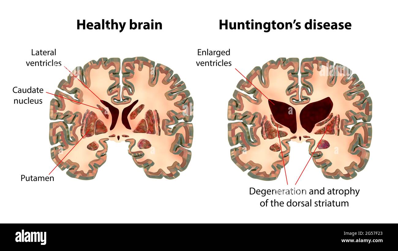 <p><strong>B (loss of cells in the caudate and putamen) (striatum)</strong> is the correct answer because it describes changes typically associated with <strong>Huntington's disease</strong>, not Parkinson's.</p>