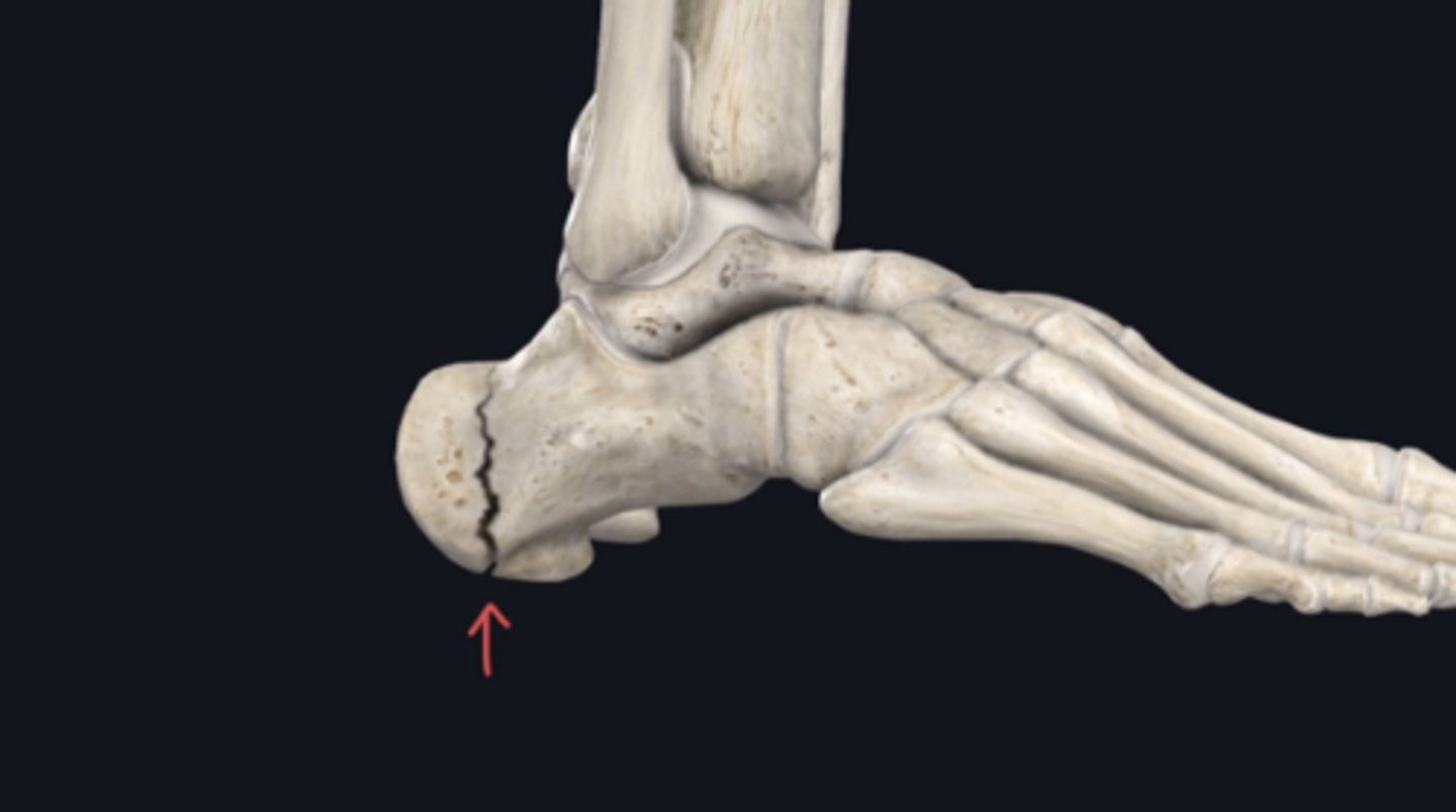 <p>Identify the plane of section in which the indicated fracture has occurred.</p>