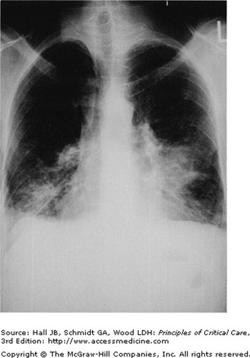 <p>The correct answer is (D).</p><p>Pneumocystis is an opportunistic fungal infection of immunocompromised patients, most frequently seen in patients with untreated HIV/AIDS. Patients often present with fever, dyspnea, a nonproductive cough, decreased arterial oxygen pressure, and tachycardia. Lung auscultation may reveal adventitious sounds, but may also be without abnormality. Chest x-ray results classically include bilateral diffuse infiltrates with perihilar involvement. Although the other etiologies are associated with pneumonia, and may be seen in immunocompromised patients, pneumocystis pneumonia occurs in up to 80% of untreated HIV patients and is a leading cause of death.</p>