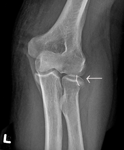 <p>Radial head fracture.</p>