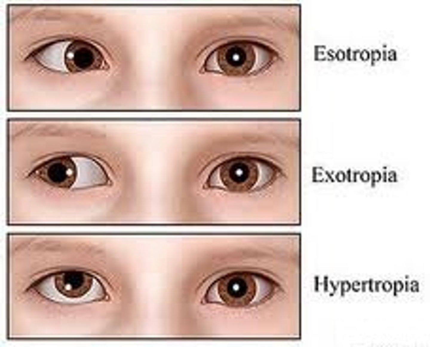 <p>A misalignment of the two eyes such that a single object in space is imaged on the fovea of one eye, and on a nonfoveal area of the other (turned) eye.</p><p>- Esotropia</p><p>- Exotropia</p><p>- loss of stereopsis</p>