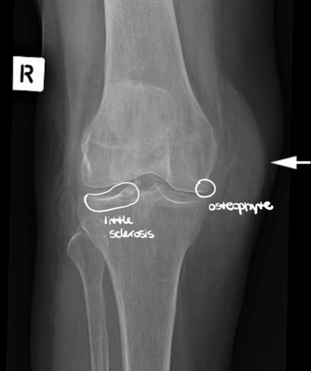 <p>1. Muscles - atrophy - swelling (ex: swelling around the knee joint as seen in this image)</p><p>2. Fat pads and fat lines</p><p>3. Joint capsules - effusion</p><p>4. Periosteum</p><p>5. Miscellaneous</p>