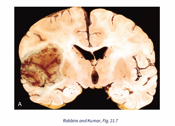 <p>Haemorrhagic Stroke</p>