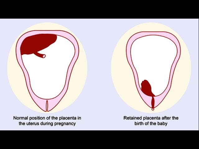 <p>placneta or fragments if the placneta remian in the uteurs an dprevent te utueres from contracting, wgich cna lead to uteirne atony or subinvolution, a placenta that has not been delievred within 30 minutes of the birth is a reatined placenta </p>