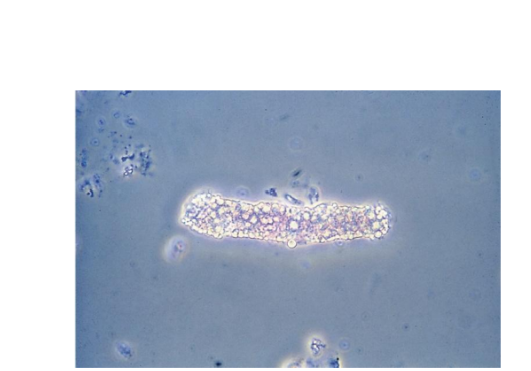 <p><span>Nephrotic syndrome, diabetes, crush</span></p><p><span>injuries, tubular necrosis</span></p><p></p><p><span>Seen with oval fat bodies (OFBs) and fat</span></p><p><span>droplets</span></p><p></p><p><span>Highly refractile, OFBs may attach to matrix</span></p><p></p><p><span>Polarized microscopy and lipid stain</span></p><p></p><p><span>Triglycerides and neutral fats stain orange</span></p>