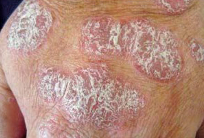 <p>what lesion is depicted</p>