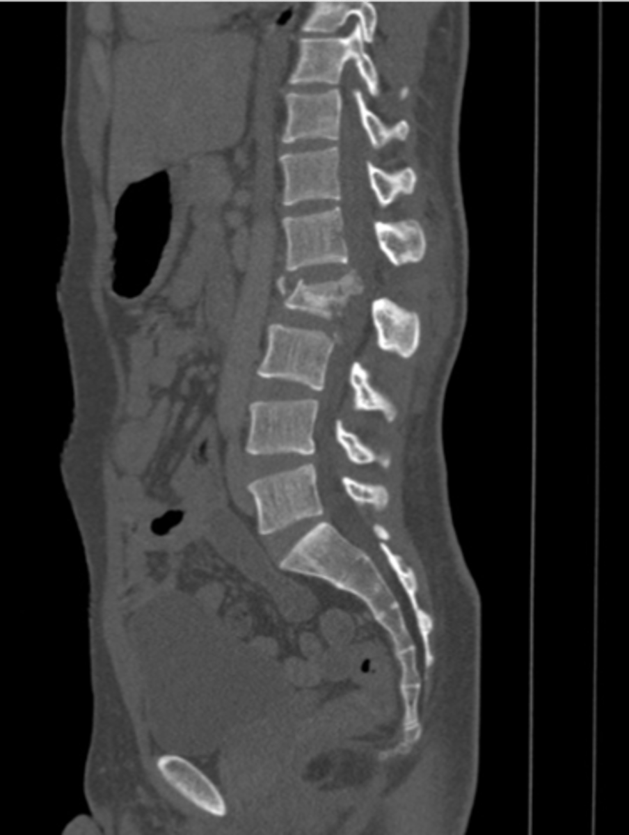 <p>An unstable traumatic flexion-distraction fracture in the area of the thoracolumbar junction</p>