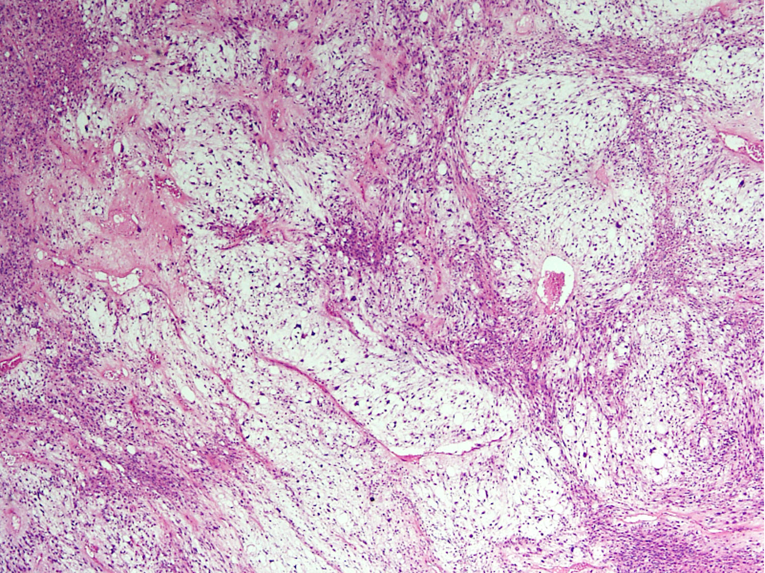 <p>Homme de 70 ans avec masse profonde de la cuisse </p><p>1) Diagnostic</p><p>2) clinique (âge, localisation, fréquence relative) </p><p>3) Histologie</p><p>4) IHC</p><p>5) Moléculaire</p><p>6) Grading</p><p>7) DD&nbsp;</p><p> </p>