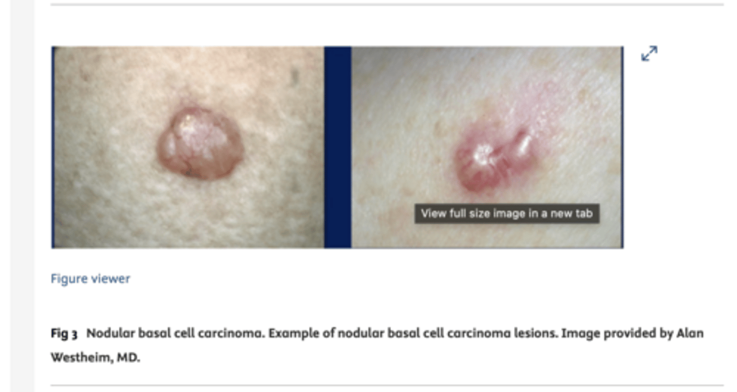 <p>- slow growing</p><p>- Usually asymptomatic (pain/bleeding rare)</p><p>- Flesh coloured nodules with central depression, pearly surface, rolled edge, and telangiectasia</p><p>- They can can necrose and ulcerate in the centre </p><p>- In sun-exposed areas. There may be background sun-damage such as actinic keratoses</p>