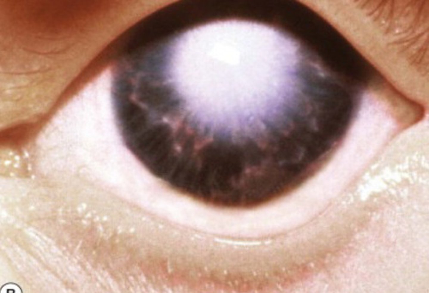 <p>Rare congenital disorder characterized by central corneal opacity with a clear peripheral cornea</p>
