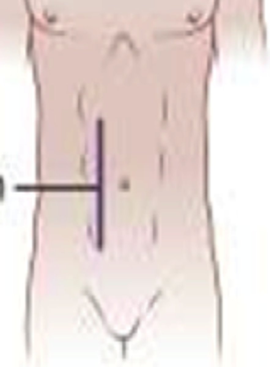 <p>what incision is this</p>