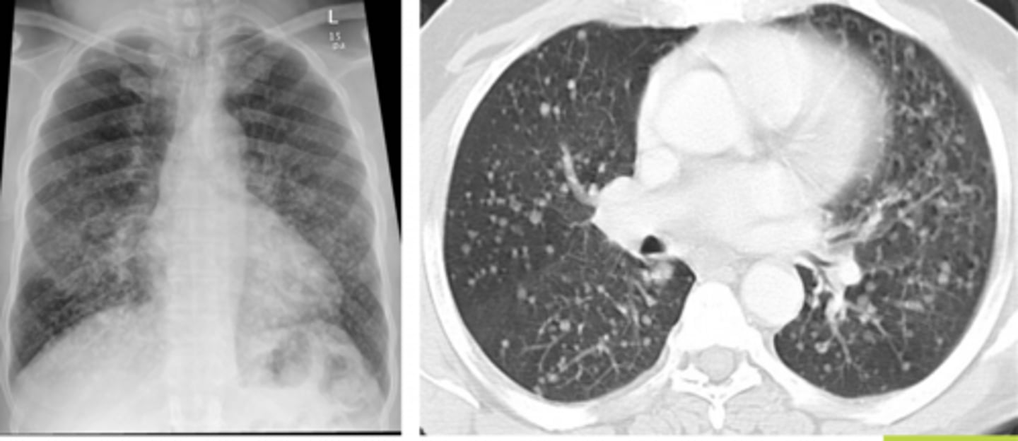 <p>Patient has a previous history of thyroid cancer</p>