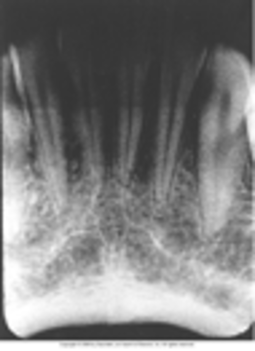 <p>Results from excessive exposure time, kVp, mA, or a combination of these factors</p>
