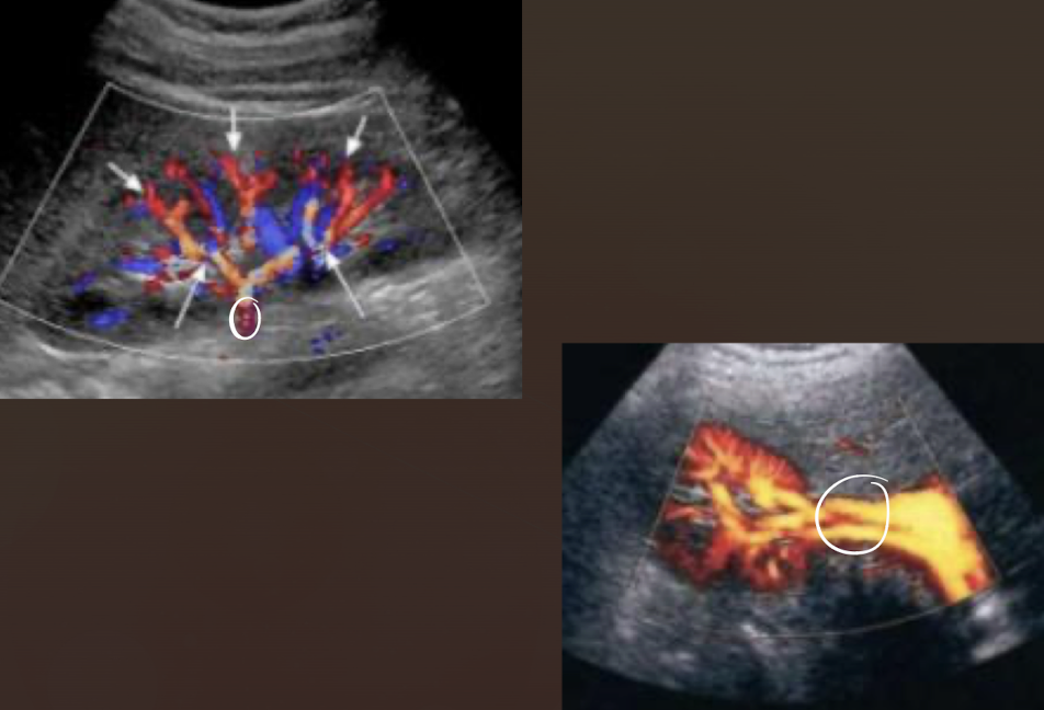 <ul><li><p><mark data-color="yellow" style="background-color: yellow; color: inherit;">medial</mark> portion of sinus where <mark data-color="yellow" style="background-color: yellow; color: inherit;">artery enters</mark> and <mark data-color="yellow" style="background-color: yellow; color: inherit;">vein and ureter exits</mark></p></li></ul><ul><li><p><span style="color: yellow;"><span>area in midportion of kidneys where renal vessels, ureter, and lymphatics enter and exit</span></span></p></li></ul><p></p>
