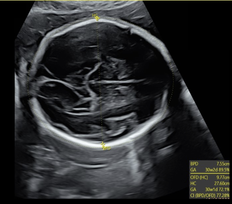 <p><strong>BPD</strong> measurements are taken from ____ edge of the skull to ___ edge of the skull</p><p>.</p><p>a) inner, inner</p><p>b) outer, inner</p><p>c) outer, outer</p><p>d) inner, outer</p>