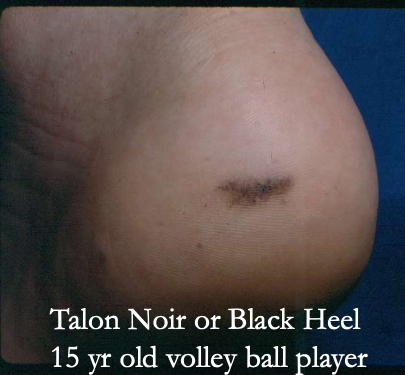 <p><span>Volleyball and basketball can cause <strong>[...]</strong> or <strong>[...]</strong></span></p>