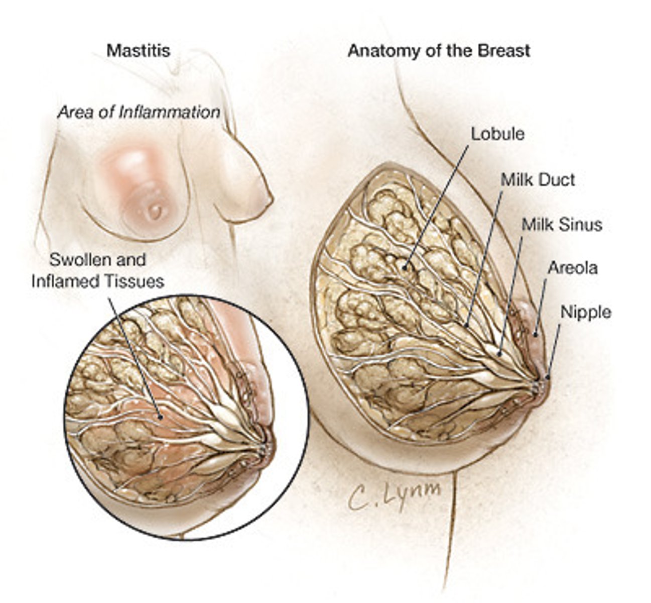 <p>Inflammation of the mammary gland.</p><p>-Most common when a woman is breastfeeding</p><p>-Usually unilateral</p><p>-Can progress to abscess if not treated</p><p>-Occurs during the first 6 weeks of breast feeding</p>