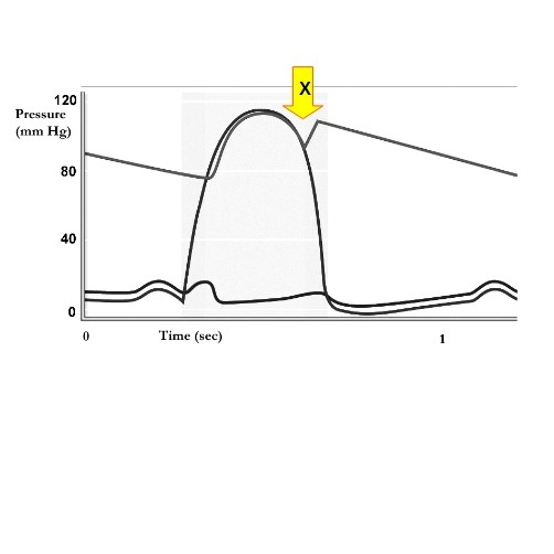 <p><span>The curves represent aortic, left ventricular, and left atrial pressure levels over time. At time X, the valve condition change in progress is:</span></p>