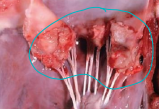 <p><span>Endocarditis</span></p>