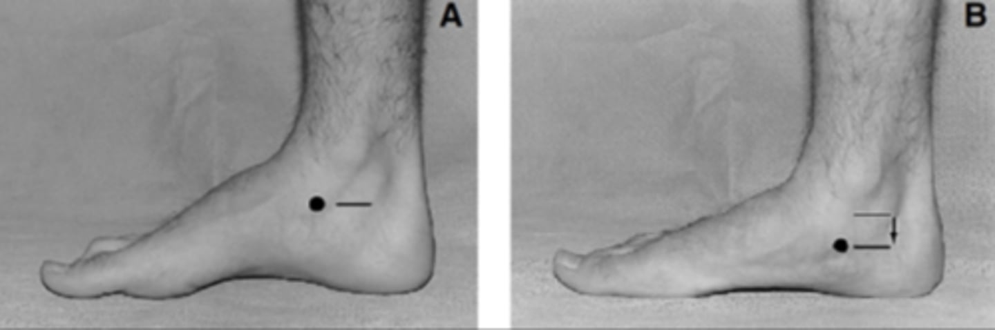 <p>Increased navicular drop value (based on the case, the MOST likely pathology is medial tibial stress syndrome -- associated w/ increased navicular drop value)</p>