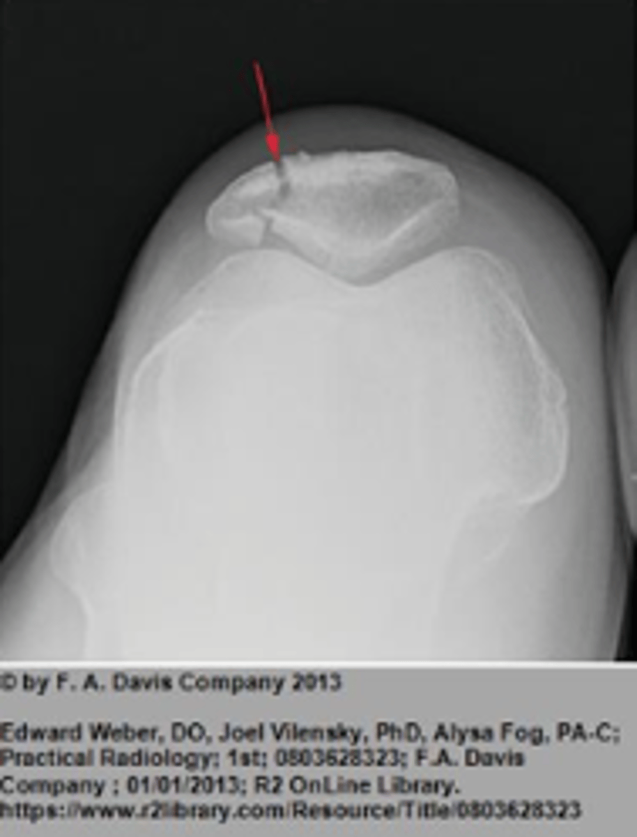 <p><strong>Lower Extremity Knee</strong> Plain films include:</p><p></p><p><strong>__________________</strong> – relationship of patella to the anterior femur</p>